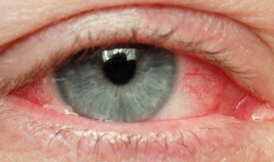 Ραγοειδίτιδα: H πιο άγνωστη ασθένεια των ματιών