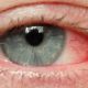 Ραγοειδίτιδα: H πιο άγνωστη ασθένεια των ματιών