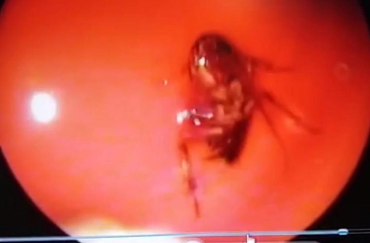 Ανατριχιαστικό :Βρέθηκε ζωντανή κατσαρίδα μέσα στο κρανίο 42χρονης! (vid)