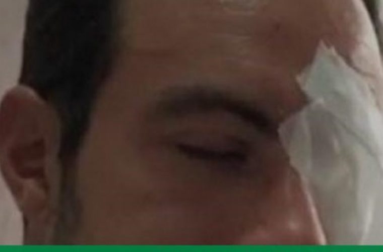 Survivor: Χτύπησε το μάτι σε αγώνα beach soccer ο Τανιμανίδης – Δείτε το περιστατικό (vid)