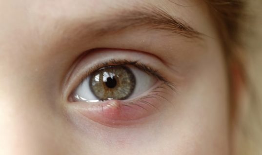 Κριθαράκι στο μάτι: Αίτια, θεραπεία και πρόληψη