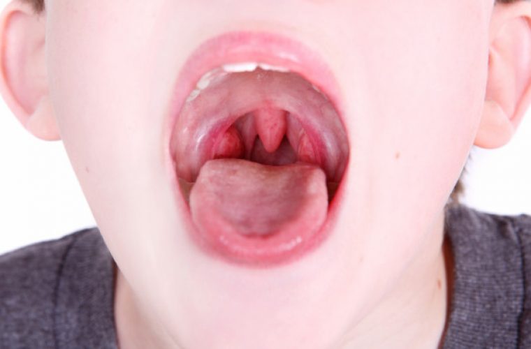 Αμυγδαλίτιδα στο παιδί: Αίτια, συμπτώματα και αντιμετώπιση