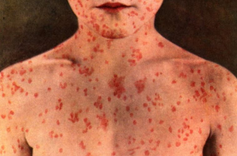 Αυτά είναι τα συμπτώματα της ιλαράς – Πώς να προφυλαχθείς