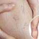 Εγκυμοσύνη: Πώς να αντιμετωπίσετε κιρσούς και ευρυαγγείες