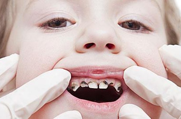 Ποιες τροφές καταστρέφουν τα δόντια των παιδιών