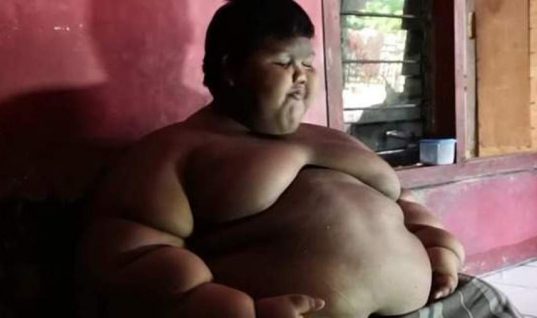 Το πιο χοντρό παιδί του κόσμου έχασε 76 κιλά – Δείτε το σήμερα (pics/vids)