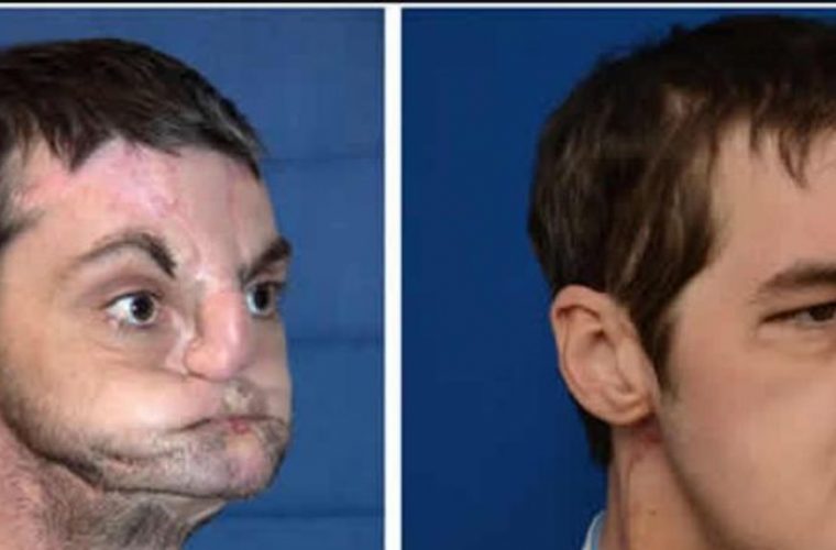 Γαλλία: Έμεινε ενάμιση μήνα χωρίς πρόσωπο αφού το σώμα του απέρριψε το μόσχευμα!