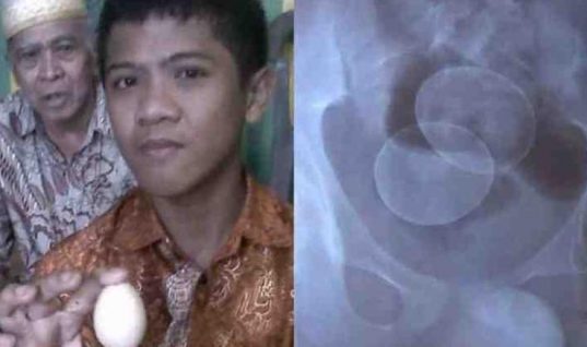Ιατρικό μυστήριο: Ενας 14χρονος «γεννά» αυγά στην Ινδονησία
