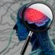Ανεύρυσμα εγκεφάλου: Τα αθώα σημάδια που φωνάζουν και αγνοούμε