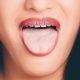 Άφτρες στο στόμα – Τι σημαίνουν, τι πρέπει να κάνετε και τι όχι