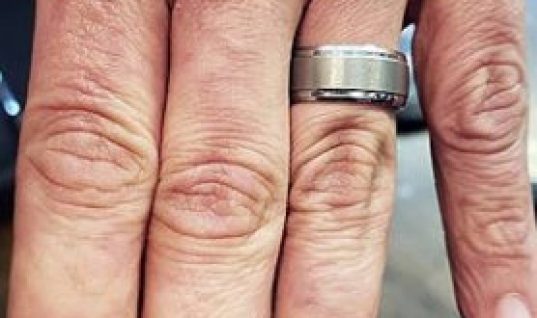 Απέκτησε ξανά τα δάχτυλά του μέσω… τατουάζ -Το αποτέλεσμα είναι εκπληκτικό (εικόνα)