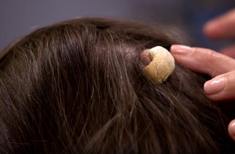 Αηδία αλλά συνέβη: Φύτρωσε κανονικό κέρατο, στο κεφάλι γυναίκας (εικόνες)