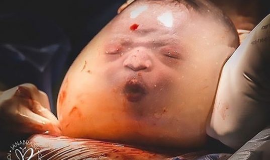 Μία φορά στις 100.000: Μητέρα γέννησε το παιδί της μέσα στον αμνιακό σάκο – Σπάνιες εικόνες