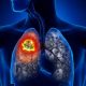 Καρκίνος του πνεύμονα: Συναγερμός στην Ελλάδα, 7.000 νέα κρούσματα το χρόνο