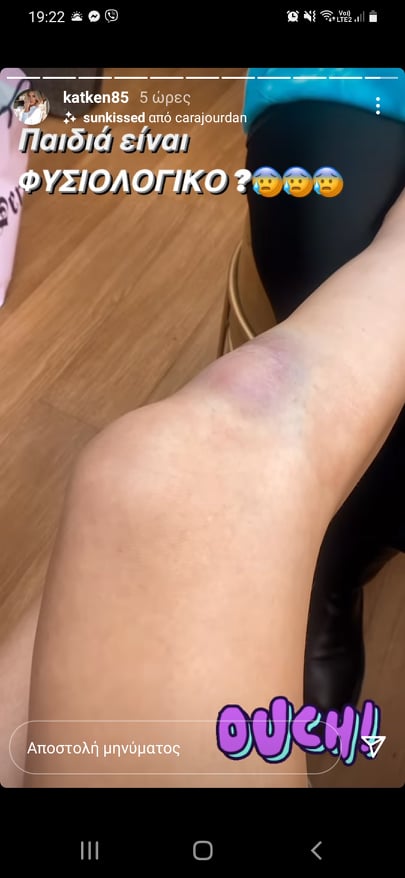Ατύχημα για την Κατερίνα Καινούργιου: «Το πόδι εδώ έχει γίνει τούμπανο»