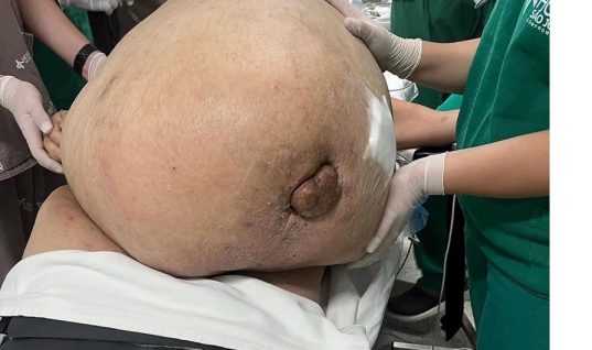 Γυναίκα είχε όγκο 45 κιλών για πέντε χρόνια – Κινητοποιήθηκαν όλοι οι εργαζόμενοι του νοσοκομείου για το περιστατικό